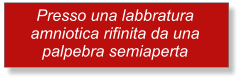 Presso una labbratura amniotica rifinita da una palpebra semiaperta